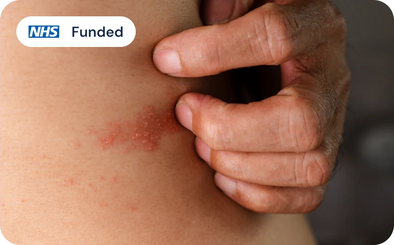Shingles (Herpes Zoster)