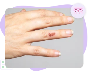 Impetigo