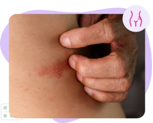 Shingles